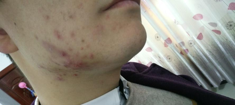 解决女生脸上出油问题的有效方法（油光满面？试试这些护理技巧）  第2张